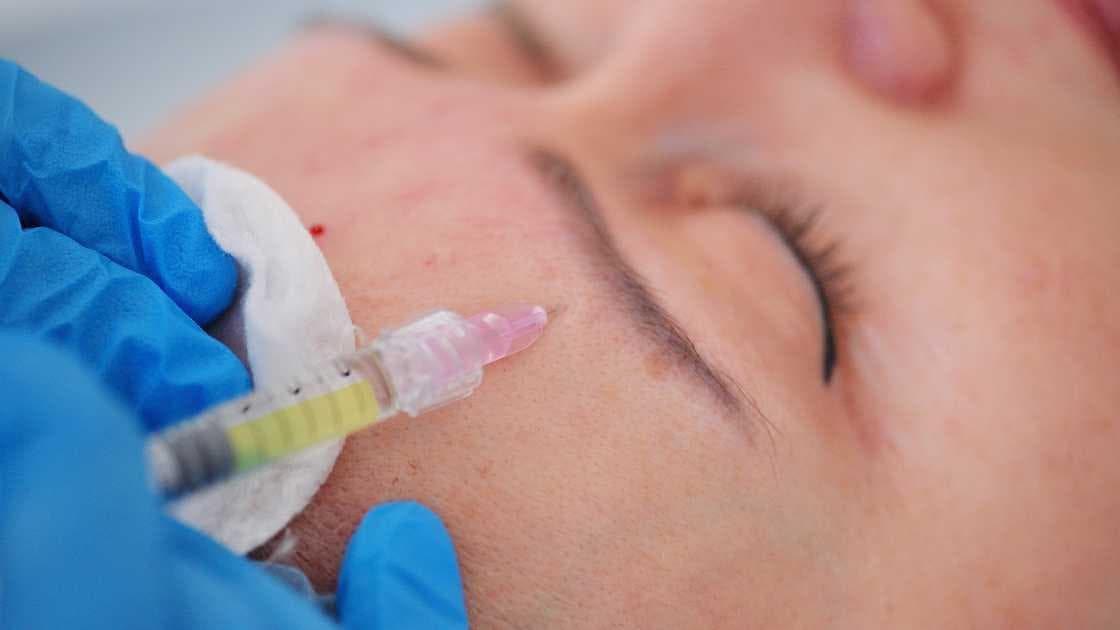 Mesotherapie gegen Falten: Eine effektive Methode zur Faltenreduzierung