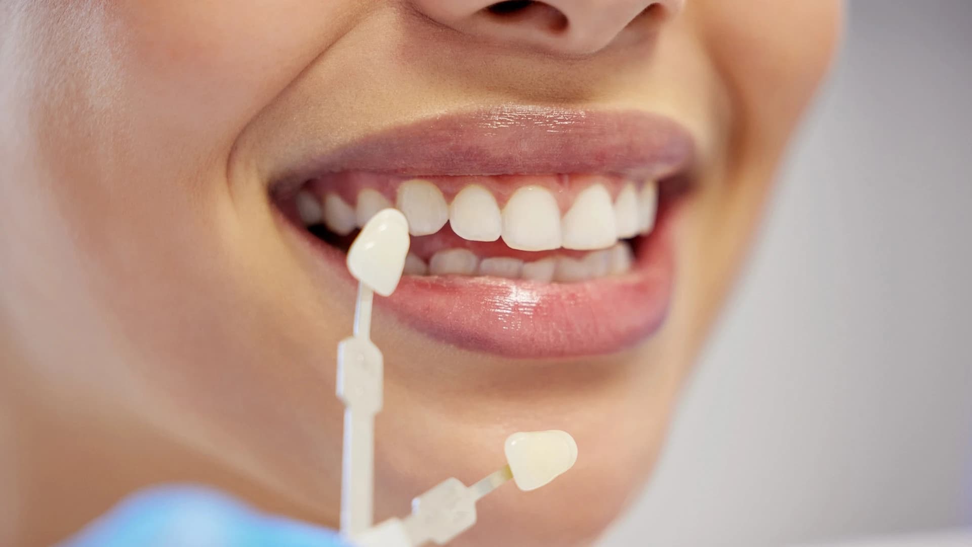 veneers kosten türkei
